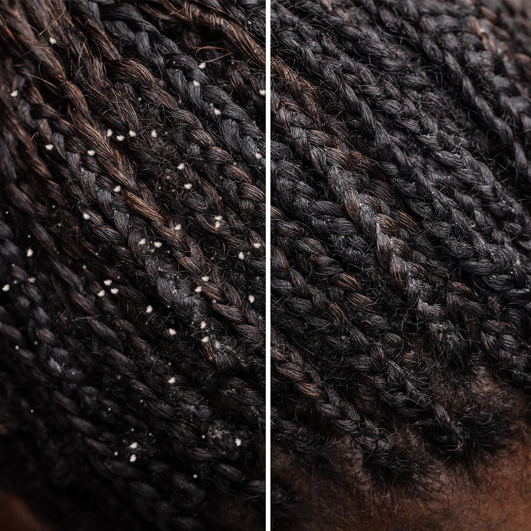 Difference_Of_Hair_With_Dandruff_And_Clean_Hair-min