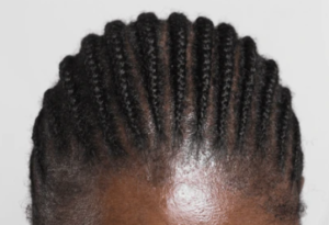 black oily scalp